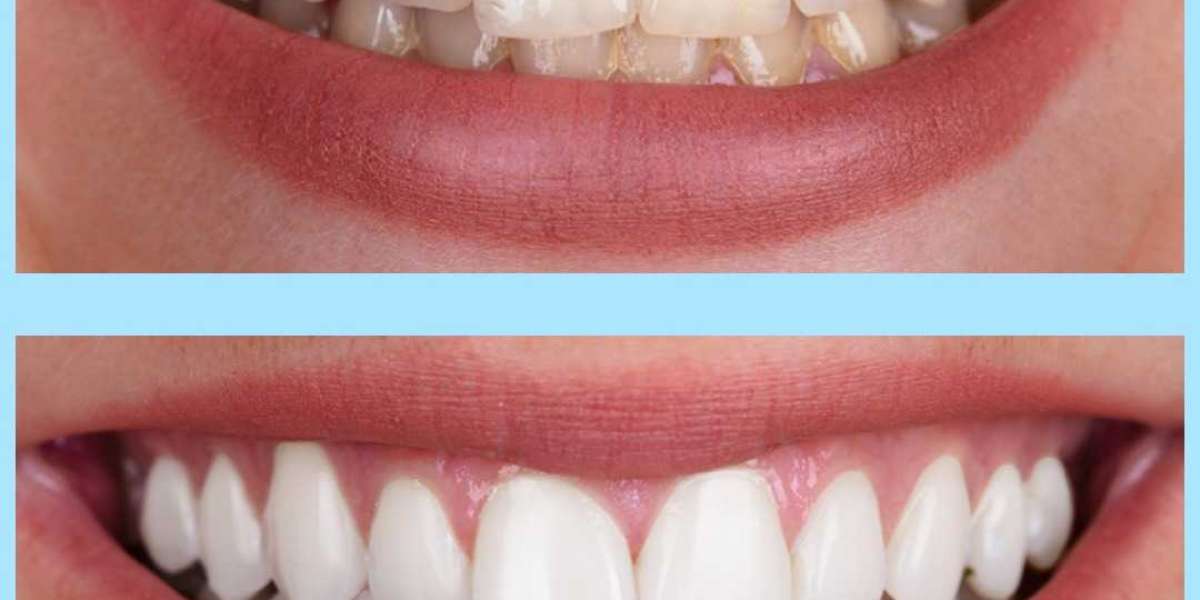 Brighten Your Smile: Exploring the Benefits of Teeth Whitening from a Skilled Dentist